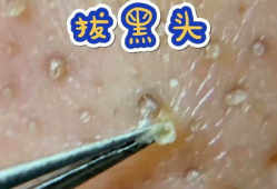 挤黑头的视频,告别毛孔堵塞烦恼